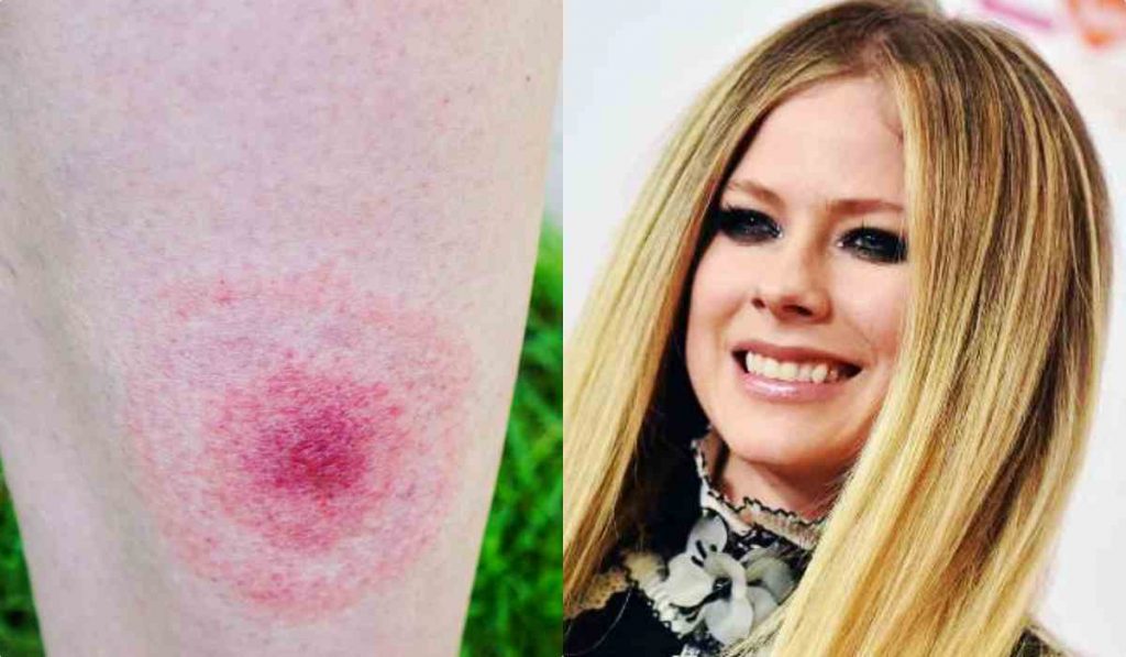 Avril Lavigne Malattia